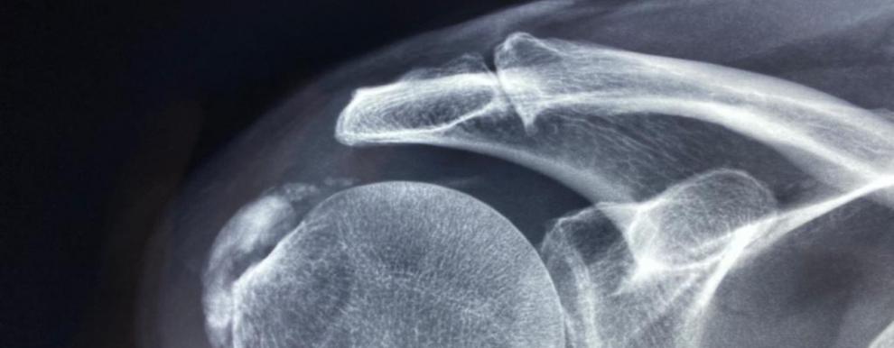 Tendinopat�a Calcificante: tratamiento con Ondas de Choque - Foto